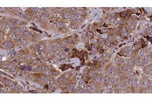 ABIN6273843 at 1/100 staining Human liver cancer tissue by IHC-P. (DRD5 抗体  (N-Term))