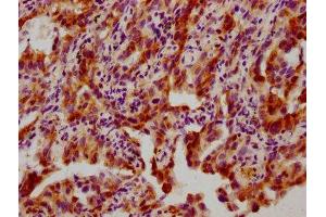 IHC image of ABIN7127701 diluted at 1:100 and staining in paraffin-embedded human lung cancer performed on a Leica BondTM system.