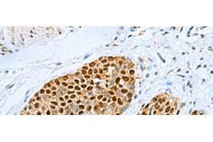 Immunohistochemistry of paraffin-embedded Human esophagus cancer tissue using TFAP4 Polyclonal Antibody at dilution of 1:70(x200) (TFAP4 抗体)