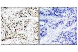 Immunohistochemical analysis of paraffin-embedded human breast carcinoma tissue using SAPK/JNK(Phospho-Thr183) Antibody(left) or the same antibody preincubated with blocking peptide(right). (JNK2 抗体  (pThr183))