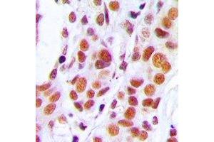 Immunohistochemical analysis of RB1 staining in human stomach cancer formalin fixed paraffin embedded tissue section.