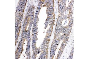 Anti-Eph receptor A1 antibody, IHC(P) IHC(P): Human Colon Cancer Tissue (EPHA1 抗体  (C-Term))