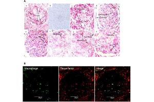 Glomerular tissue factor expression in biopsy tissues. (Streptavidin Protein (Rhodamine))