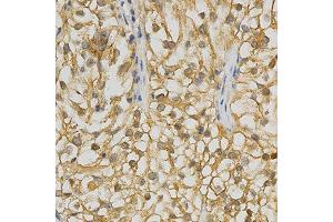 Immunohistochemistry of paraffin-embedded human kidney cancer using ADRBK2 antibody at dilution of 1:200 (x400 lens)