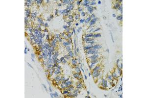 Immunohistochemistry of paraffin-embedded human gastric cancer using SLC27A2 antibody (ABIN5970435) at dilution of 1/100 (40x lens). (SLC27A2 抗体)