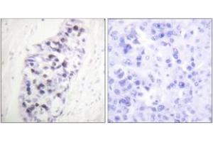 Immunohistochemistry analysis of paraffin-embedded human lung carcinoma tissue, using HDAC1 Antibody. (HDAC1 抗体  (AA 433-482))