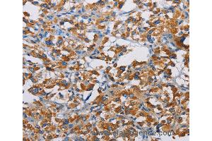 Immunohistochemistry of Human liver cancer using TSPEAR Polyclonal Antibody at dilution of 1:50 (TSPEAR 抗体)