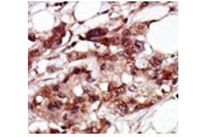 IHC analysis of FFPE human breast carcinoma tissue stained with the BRD4 antibody (BRD4 抗体  (AA 1313-1342))