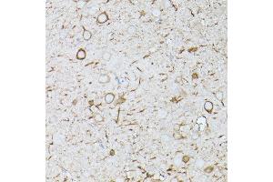 Immunohistochemistry of paraffin-embedded human colon carcinoma using NRF2 Rabbit pAb (ABIN3021831, ABIN3021832, ABIN3021833, ABIN1513258 and ABIN6216065) at dilution of 1:25 (40x lens). (NRF2 抗体  (AA 366-605))