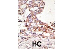 Formalin-fixed and paraffin-embedded human hepatocellular carcinoma tissue reacted with the SUMO4 polyclonal antibody  , which was peroxidase-conjugated to the secondary antibody, followed by AEC staining. (SUMO4 抗体  (Internal Region))