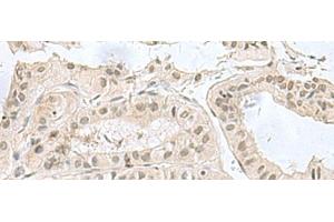 Immunohistochemistry of paraffin-embedded Human thyroid cancer tissue using PCBD1 Polyclonal Antibody at dilution of 1:60(x200) (PCBD1 抗体)