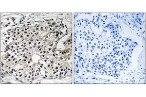 Immunohistochemistry analysis of paraffin-embedded human breast carcinoma tissue, using PECI Antibody. (PECI/ECI2 抗体  (AA 73-122))