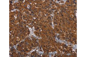 Immunohistochemistry of Human renal cancer using HYAL2 Polyclonal Antibody at dilution of 1:60 (HYAL2 抗体)