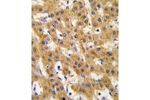 Formalin-fixed and paraffin-embedded human hepatocarcinoma tissue reacted with Phospho-PDX1-T11. (PDX1 抗体  (AA 1-30))