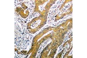 Immunohistochemical analysis of p53 staining in human colon cancer formalin fixed paraffin embedded tissue section. (p53 抗体  (C-Term))