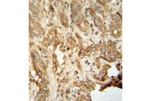 Immunohistochemistry analysis in formalin fixed and paraffin embedded human hepatocarcinoma reacted with NAT14 Antibody (N-term) followed which was peroxidase conjugated to the secondary antibody and followed by DAB staining. (NAT14 抗体  (N-Term))