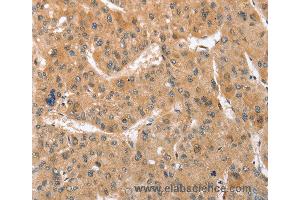 Immunohistochemistry of Human gastric cancer using ATG12 Polyclonal Antibody at dilution of 1:70 (ATG12 抗体)