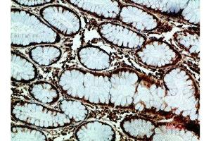 Immunohistochemical analysis of paraffin-embedded human-colon-cancer, antibody was diluted at 1:200 (GRP78 抗体  (AA 1268-1341))