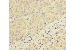 Immunohistochemistry of paraffin-embedded human liver cancer using ABIN7162979 at dilution of 1:100 (PEX16 抗体  (AA 132-336))