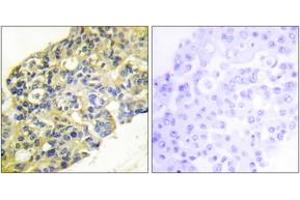 Immunohistochemistry analysis of paraffin-embedded human breast carcinoma tissue, using PI3-kinase p85-alpha/gamma (Ab-467/199) Antibody. (PI3K p85 alpha/gamma 抗体  (AA 436-485))