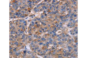 Immunohistochemistry of Human liver cancer using NPM3 Polyclonal Antibody at dilution of 1:60 (NPM3 抗体)