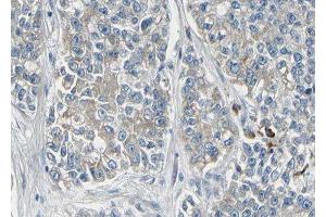 ABIN6278486 at 1/100 staining human lung carcinoma tissue sections by IHC-P. (KCNMA1 抗体  (Internal Region))