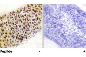 Immunohistochemical analysis of paraffin-embedded human liver carcinoma tissue using KAT5 polyclonal antibody . (KAT5 抗体)