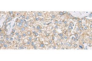 Immunohistochemistry of paraffin-embedded Human liver cancer tissue using SHC3 Polyclonal Antibody at dilution of 1:40(x200) (SHC3 抗体)