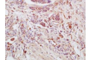 Formalin-fixed and paraffin embedded human lung carcinoma tissue labeled with Anti-FAM135B Polyclonal Antibody, Unconjugated (ABIN1386912) at 1:200 followed by conjugation to the secondary antibody and DAB staining. (FAM135B 抗体  (AA 1080-1130))