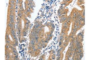 The image on the left is immunohistochemistry of paraffin-embedded Human colon cancer tissue using ABIN7128903(CENPC Antibody) at dilution 1/70, on the right is treated with fusion protein. (Centromere Protein C Pseudogene 1 (CENPCP1) 抗体)