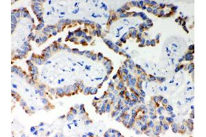 Anti- ITPR3 Picoband antibody, IHC(P) IHC(P): Human Lung Cancer Tissue (ITPR3 抗体  (N-Term))