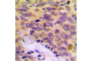 Immunohistochemical analysis of MRPL16 staining in human breast cancer formalin fixed paraffin embedded tissue section. (MRPL16 抗体  (C-Term))