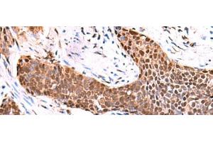 Immunohistochemistry of paraffin-embedded Human esophagus cancer tissue using TSEN2 Polyclonal Antibody at dilution of 1:80(x200) (TSEN2 抗体)