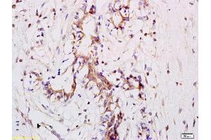 Formalin-fixed and paraffin embedded human breast carcinoma labeled with Anti CD11a Polyclonal Antibody, Unconjugated (ABIN734678) at 1:200 followed by conjugation to the secondary antibody and DAB staining (ITGAL 抗体  (AA 251-350))