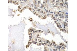 Immunohistochemistry of paraffin-embedded Human thyroid cancer using GTF2F1 Polyclonal Antibody at dilution of 1:200 (40x lens). (GTF2F1 抗体)