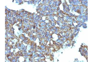 Formalin-fixed, paraffin-embedded human Ovarian Carcinoma stained with CD99 Monoclonal Antibody (MIC2/877). (CD99 抗体)