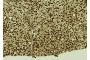 ABIN6272432 at 1/100 staining Human breast cancer tissue by IHC-P. (Sp3/4 抗体)