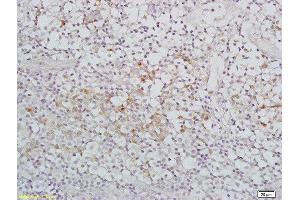 Formalin-fixed and paraffin embedded human nasopharyngeal carcinoma labeled with Rabbit Anti-IGFBP7 Polyclonal Antibody, Unconjugated  at 1:200 followed by conjugation to the secondary antibody and DAB staining (IGFBP7 抗体  (AA 131-230))