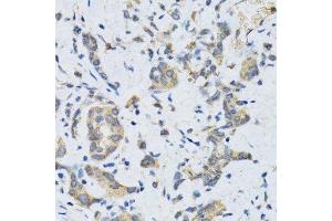 Immunohistochemistry of paraffin-embedded human gastric cancer using SLC2A13 antibody. (SLC2A13 抗体  (AA 564-648))
