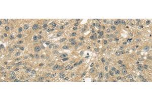 Immunohistochemistry of paraffin-embedded Human breast cancer tissue using UGT2B4 Polyclonal Antibody at dilution 1:45 (UGT2B4 抗体)