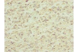 Immunohistochemistry of paraffin-embedded human glioma using ABIN7151143 at dilution of 1:100 (RNF13 抗体  (AA 204-381))