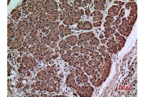 Immunohistochemistry (IHC) analysis of paraffin-embedded Human Pancreas Cancer, antibody was diluted at 1:100. (SERPINA3 抗体  (Internal Region))
