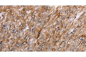 Immunohistochemistry of paraffin-embedded Human esophagus cancer using GRPR Polyclonal Antibody at dilution of 1:40 (GRPR 抗体)
