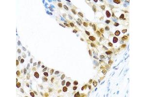 Immunohistochemistry of paraffin-embedded Human prostate cancer using KHDRBS2 Polyclonal Antibody at dilution of 1:100 (40x lens). (KHDRBS2 抗体)
