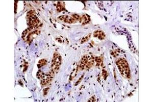 Immunostaining of paraformldehyde-fixed and paraffin-embedded hun breast carcino with GE-A4 antibody Cat (ABIN390108 and ABIN2840620) (1:50 dilution), followed by reacting with biotin-conjugated secondary antibody, ABC solution and developing with DAB. (MAGEA4 抗体  (N-Term))