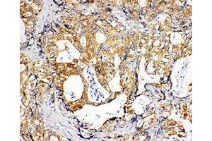 IHC-P: SDHC antibody testing of human gastric cancer tissue (SDHC 抗体  (N-Term))