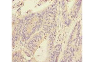 Immunohistochemistry of paraffin-embedded human colon cancer using ABIN7170628 at dilution of 1:100 (RBM17 抗体  (AA 1-240))