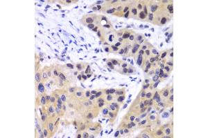 Immunohistochemistry of paraffin-embedded human esophageal cancer using IRF3 antibody (ABIN4904079) at dilution of 1:100 (40x lens). (IRF3 抗体)
