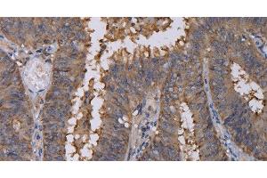 Immunohistochemistry of paraffin-embedded Human colon cancer using REG3G Polyclonal Antibody at dilution of 1:40 (REG3g 抗体)
