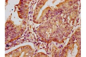 IHC image of ABIN7151049 diluted at 1:100 and staining in paraffin-embedded human endometrial cancer performed on a Leica BondTM system. (RNF160 抗体  (AA 462-591))